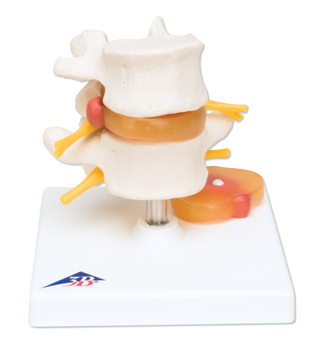 进口椎间盘脱出腰脊柱模型-德国3B-A76