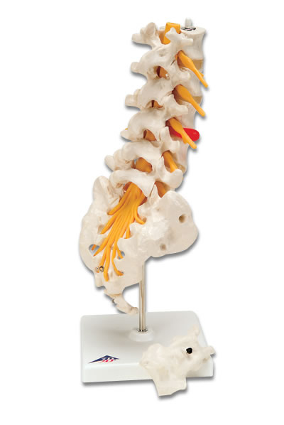 进口腰脊柱-有脊外侧椎间盘脱出-德国3B-A76/5